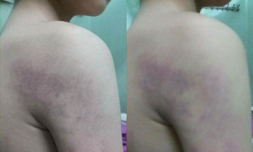 Hình ảnh học sinh T. bị cô giáo H. đánh thâm tím trước đó.