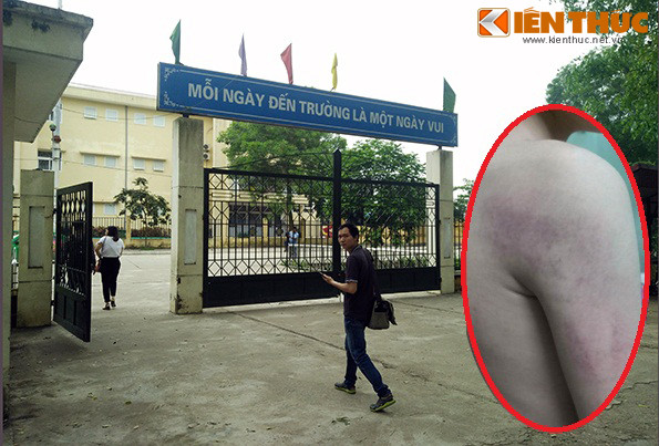 Theo Hiệu trưởng nhà trường thì cháu T. bị cô giáo đánh thâm tím vai (ảnh nhỏ) trong lớp học.