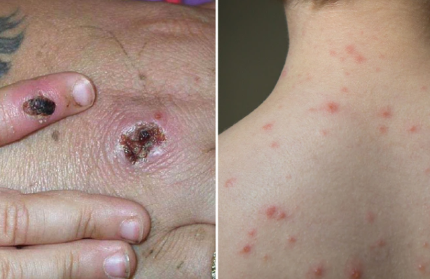 Diem khac biet nhat giua benh dau mua khi va thuy dau