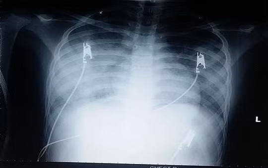 Kết quả chụp phim cho thấy, bé T.N.A. (13 tuổi, ngụ ở Bình Phước) bị viêm phổi rất nặng Kết quả chụp phim cho thấy, bé T.N.A. (13 tuổi, ngụ ở Bình Phước) bị viêm phổi rất nặng