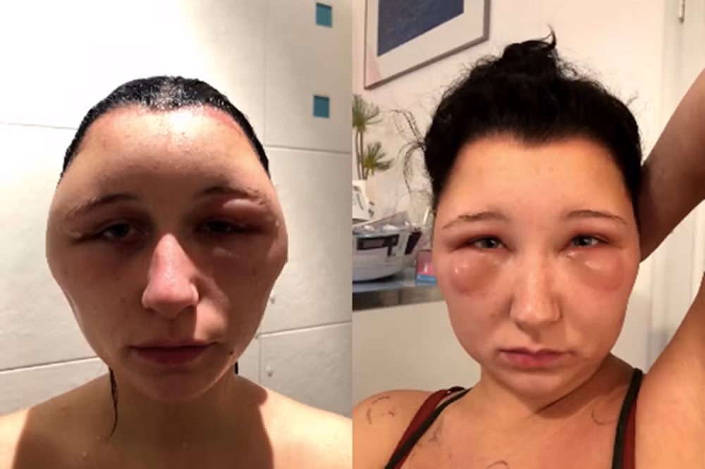 Nhuộm tóc làm đẹp, đầu thiếu nữ 19 tuổi bỗng to gấp đôi - Hình 2 Nhuom toc lam dep, dau thieu nu 19 tuoi bong to gap doi-Hinh-2