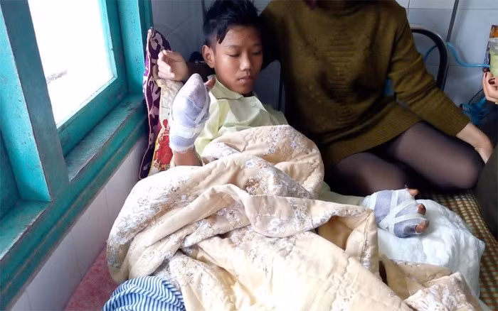 Em Thắng bị bỏng ở ngực, hai chân, còn hai bàn tay bị dập nát.