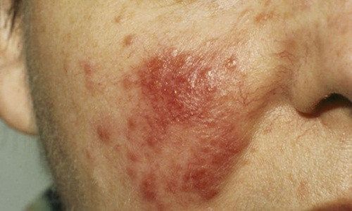 Nếu khuôn mặt luôn đỏ như đang xấu hổ về chuyện gì đó thì rất có thể bạn đã mắc bệnh rosacea. Ảnh minh họa. Nếu khuôn mặt luôn đỏ như đang xấu hổ về chuyện gì đó thì rất có thể bạn đã mắc bệnh rosacea. Ảnh minh họa.