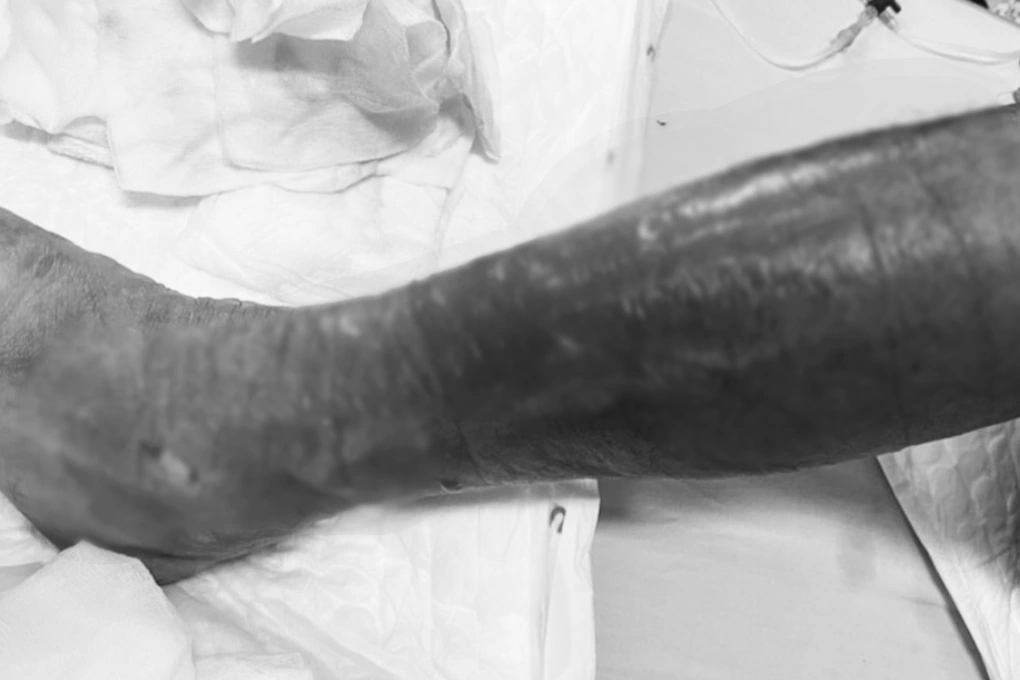 Loi bun, nguoi dan ong bi vi khuan la “an” tu chan len bung