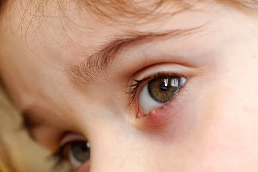 5 nguyen nhan gay ra tinh trang noi u tren mi mat-Hinh-5