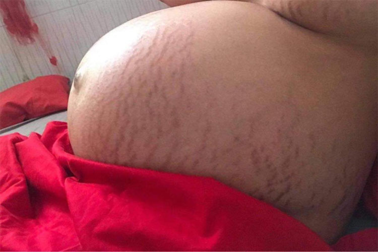 Bụng và ngực của Thu Thảo cũng bị rạn rất nhiều vì mang thai đôi.