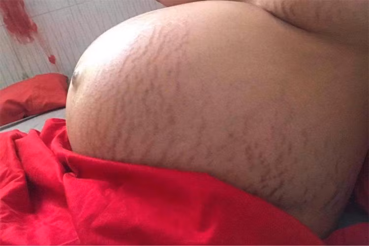 Bụng và ngực của Thu Thảo cũng bị rạn rất nhiều vì mang thai đôi.