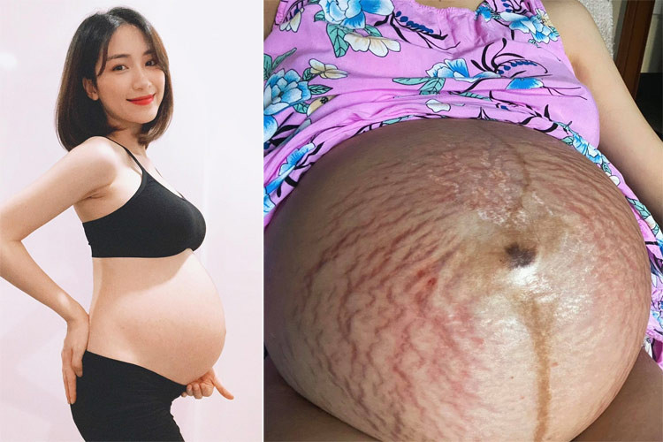 Hoà Minzy lúc mang bầu bé Bo 7 tháng, bụng chưa bị rạn (trái) và bụng khi sắp sinh được cô miêu tả trên trang cá nhân: "Cái bụng nặng trĩu như quả bóng nước".
