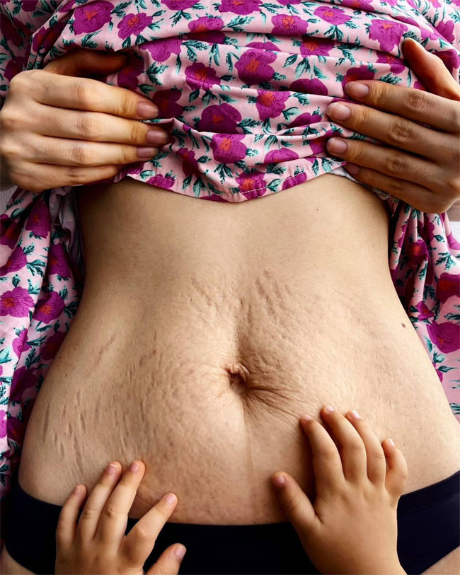 Con trai đã hơn hai tuổi nhưng bụng của Hoà Minzy vẫn còn hằn in những vết rạn.