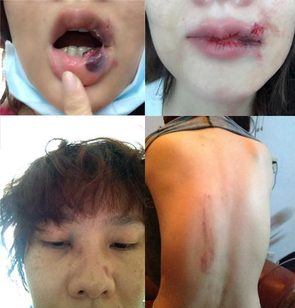 Trước Hoàng Yến, không ít mỹ nhân Việt từng tố bị chồng hành hung. Theo đó, cựu người mẫu Dương Yến Ngọc từng gây xôn xao khi tố bị người chồng thứ 2 bạo hành một cách nặng nề chỉ vì ghen tuông vô cớ. Người đẹp cho biết đã phải thoát khỏi cuộc hôn nhân này vì sự an toàn của bản thân lẫn con trai.