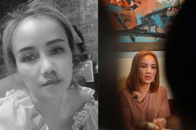 Hình ảnh Hoàng Yến bị chồng cũ đánh chảy máu mũi, gãy mũi vào ngày 24/6/2021. (Ảnh: saostar)