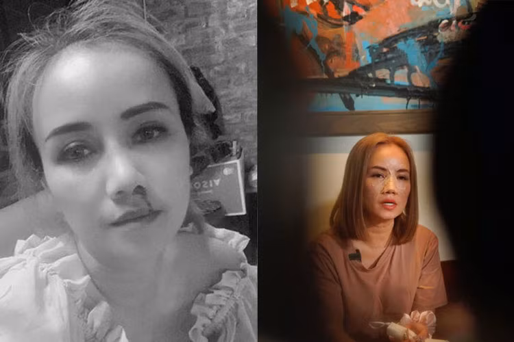 Hình ảnh Hoàng Yến bị chồng cũ đánh chảy máu mũi, gãy mũi vào ngày 24/6/2021. (Ảnh: saostar)