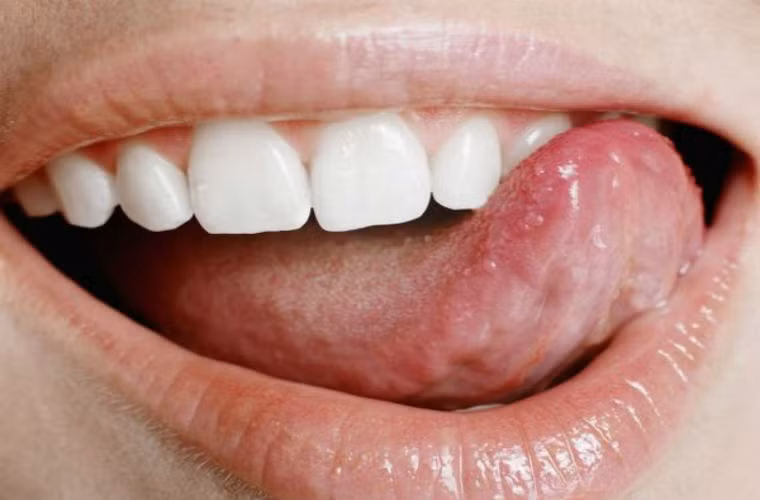  Một tuýp người nữa cũng khiến chị em có nguy cơ mắc ung thư cao. Theo kết luận của một chuyên gia nghiên cứu thuộc đại học Yale Hoa Kỳ người có vị giác quá mức nhạy cảm có nguy cơ mắc bênh ung thư ruột cao hơn những người khác. Chuyên gia này đã tiến hành nghiên cứu trên 200 người bị mắc bệnh ung thư ruột, khoảng ¼ người có vị giác nhạy cảm bẩm sinh, gai vị giác trên đầu mặt lưỡi nhiều hơn rõ rệt so với người bình thường. 