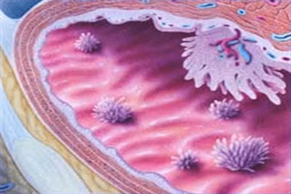 Nhan biet ung thu bang quang qua nuoc tieu