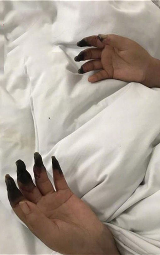 Hai ban tay bi hoai tu den si vi ly do nhieu nguoi van hay mac phai-Hinh-2