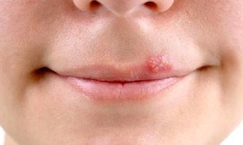 Herpes Nhiễm trùng. Là bệnh do virus Varicella zoster gây bệnh thủy đậu và herpes simplex (mụn rộp ở miệng). Herpes có thể lây lan dễ dàng nếu như mụn bị vỡ khi cơ miệng bị ép chặt khi hôn nhau. Ngay cả khi mụn này đã khỏi thì virus cũng còn sót lại và có cơ hội lây lan.