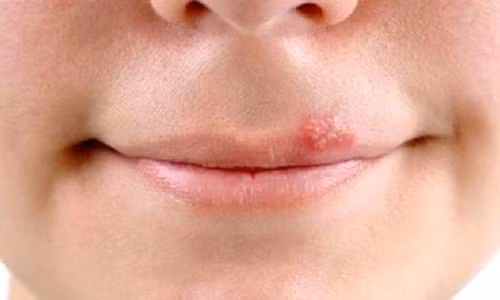 Herpes Nhiễm trùng. Là bệnh do virus Varicella zoster gây bệnh thủy đậu và herpes simplex (mụn rộp ở miệng). Herpes có thể lây lan dễ dàng nếu như mụn bị vỡ khi cơ miệng bị ép chặt khi hôn nhau. Ngay cả khi mụn này đã khỏi thì virus cũng còn sót lại và có cơ hội lây lan.