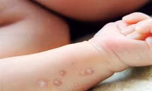 Bệnh tay chân miệng. Bệnh này do vi rút coxackie gây ra. Vi rút này có thể truyền từ người này sang người khác bởi vết thương hở trong miệng, nó phổ biến trong trẻ nhỏ, đặc biệt là những trẻ đi mẫu giáo.