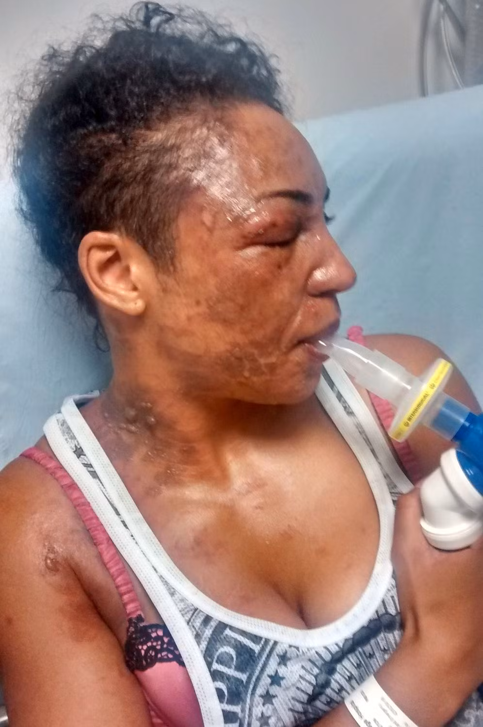 Cô được đưa tới bệnh viện Chelsea and Westminster để chữa trị. Dù các bác sĩ đã cố gắng hết sức nhưng những vết sẹo lớn vẫn để lại trên mặt của Tysha.