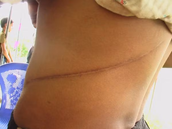 “Thủ tục chỉ mất khoảng 1 giờ nhưng tôi vẫn ở bệnh viện thêm vài ngày. Tuy nhiên, khi tỉnh dậy sau ca mổ, tôi cảm thấy không có chuyện gì xảy ra và rất ngạc nhiên khi biết mình đã được lấy thận đi rồi. Sau đó, tôi được trả 200.000 rupee Nepal và trở về nhà, sắm được nhà riêng và một số mảnh đất”.