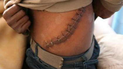 Không phải cuộc giao dịch nào cũng có sự đồng thuận của cả đôi bên. Đôi khi, nạn nhân bị bắt cóc để lấy thận hoặc bị lừa do kiến thức về sức khỏe không có. Một số nạn nhân còn bị giết chết để lấy 2 quả thận.