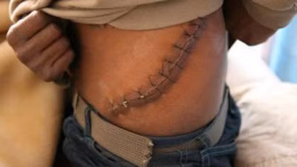 Không phải cuộc giao dịch nào cũng có sự đồng thuận của cả đôi bên. Đôi khi, nạn nhân bị bắt cóc để lấy thận hoặc bị lừa do kiến thức về sức khỏe không có. Một số nạn nhân còn bị giết chết để lấy 2 quả thận.