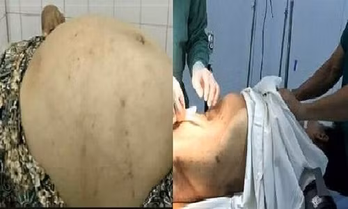 Tuong beo bung, di kham moi phat hien khoi u gan 20kg