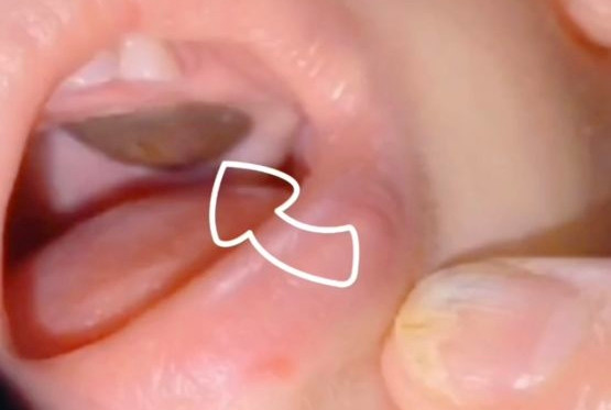 Bac si doa trong mieng co khoi u: Su that tuc nghen