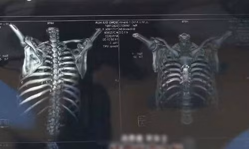 Dau lung sau khi di massage, co gai phat hien chuyen kinh di