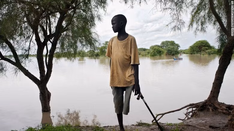 Người đàn ông bị cắt rời chân vì nọc độc rắn. Người đàn ông bị cắt rời chân vì nọc độc rắn.