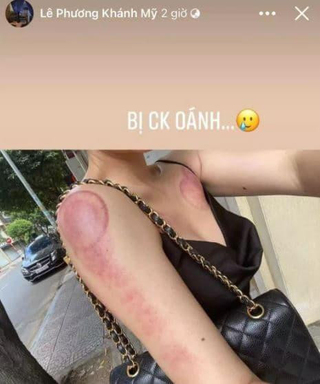 Cách đây không lâu, Vân Navy gây chú ý khi đăng tải hình ảnh để lộ cơ thể khác lạ: Phần cánh tay và lưng xuất hiện dày đặc vết đỏ, bầm tím.