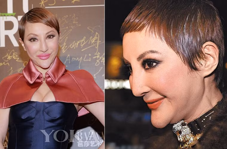 Đặc biệt chiếc cằm của Tiết Chỉ Luân sau mỗi lần phẫu thuật lại nhọn hoắt và dài ra khiến khuôn mặt của cô ngày càng khác người.