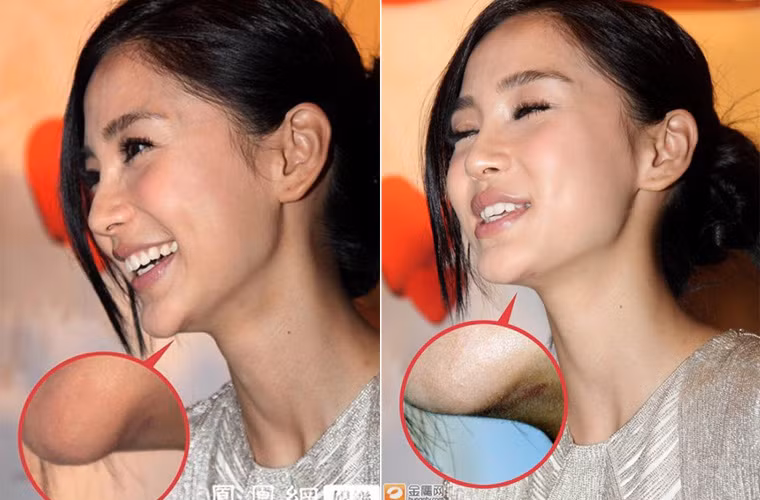 Mặc dù làm mọi cách để chứng minh rằng mình không phẫu thuật thẩm mỹ, nhưng chỉ cần so ảnh trước kia và bây giờ của Angelababy thì chẳng ai tin những gì cô nói. Đặc biệt khi cô bị lộ nguyên một chiếc sẹo to tướng ở cằm, minh chứng cho lần dao kéo độn cằm.