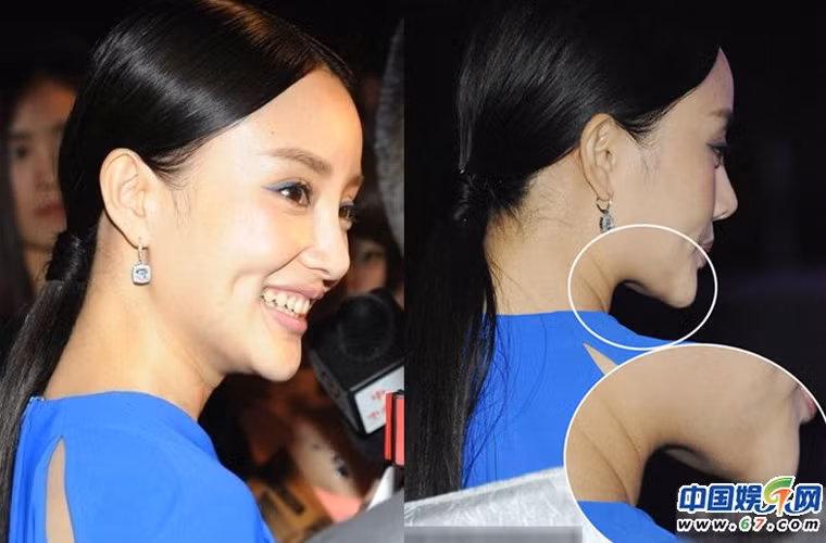 Khi chụp nghiêng, cận cảnh vào chiếc cằm của Lý Tiểu Lộ thì nghi vấn cô dao kéo độn cằm lại càng chính xác.