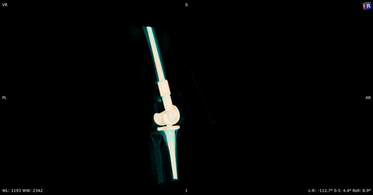 Lan dau tien thay thanh cong xuong khop nhan tao in 3D cho benh nhan khuyet tat 18 nam-Hinh-3