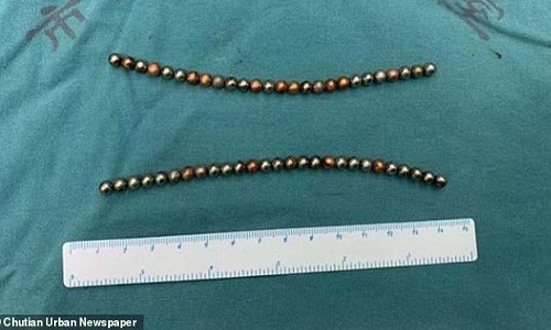 Thieu nien nghich dai, suyt chet vi nhet 53 vien bi vao “cua quy“