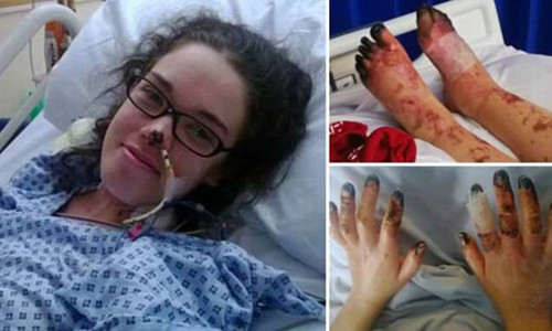 Sophie Royce (23 tuổi) sống tại thị trấn Reigate, Surrey (Anh) được chẩn đoán mắc bệnh viêm não từ năm 2013. Cô được cha mẹ đi cấp cứu trong tình trạng huyết áp và nhịp tim giảm dần, toàn bộ cơ thể bầm tím do nhiễm chủng vi khuẩn dạng hiếm W-135. Sau 8 tuần chiến đấu với bệnh tật, Sophie may mắn sống sót nhưng các ngón tay, ngón chân của cô đã bị vi khuẩn 'ăn mòn' dẫn đến hoại tử.