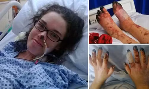 Sophie Royce (23 tuổi) sống tại thị trấn Reigate, Surrey (Anh) được chẩn đoán mắc bệnh viêm não từ năm 2013. Cô được cha mẹ đi cấp cứu trong tình trạng huyết áp và nhịp tim giảm dần, toàn bộ cơ thể bầm tím do nhiễm chủng vi khuẩn dạng hiếm W-135. Sau 8 tuần chiến đấu với bệnh tật, Sophie may mắn sống sót nhưng các ngón tay, ngón chân của cô đã bị vi khuẩn 'ăn mòn' dẫn đến hoại tử.