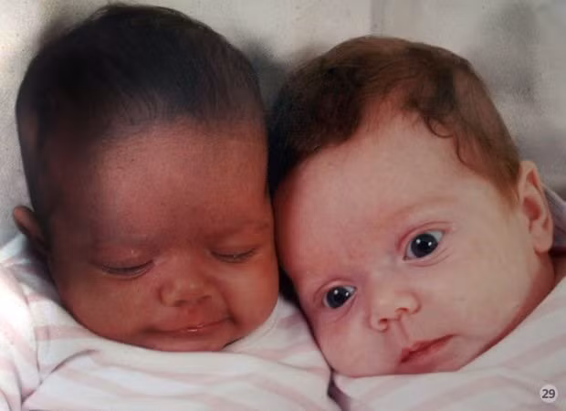 Hồi năm 2010, người phụ nữ 24 tuổi, sống ở Istanbul, Thổ Nhĩ kỳ đã thừa nhận có quan hệ tình dục với cả chồng và người tình cùng một ngày và cặp song sinh cũng được thụ thai vào cùng ngày đó.