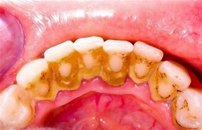 Meo lam sach cao rang don gian tai nha