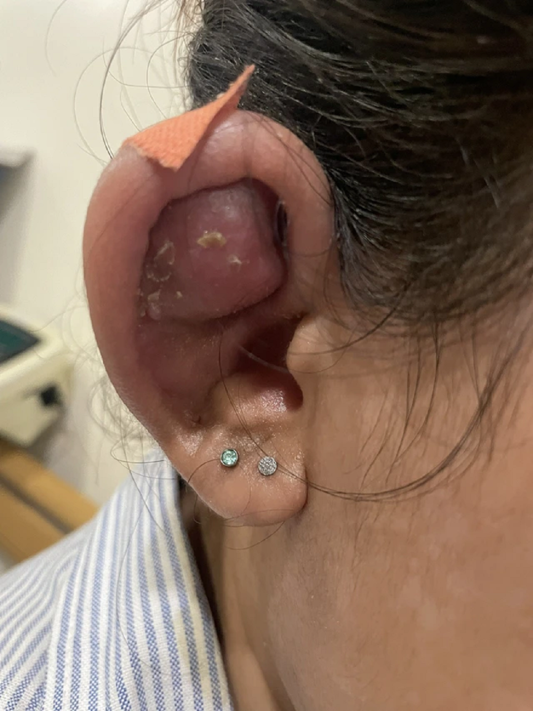 Xo khuyen lam dep, thieu nu bi tai bien viem sun vanh tai