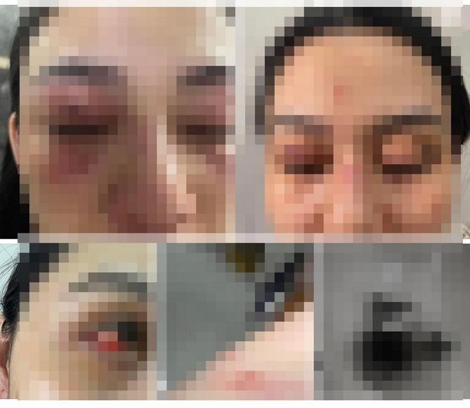 Theo kết luận giám định pháp y, chị Khanh bị đa chấn thương phần mềm, sưng bầm rải rác các bộ phận trên cơ thể, tỷ lệ tổn thương do thương tích gây nên 3%, riêng chị Yến không ghi nhận thương tích. Tại Công an, Trang, Quy, Khương, Tuấn và Nam thừa nhận hành vi vi phạm của mình.