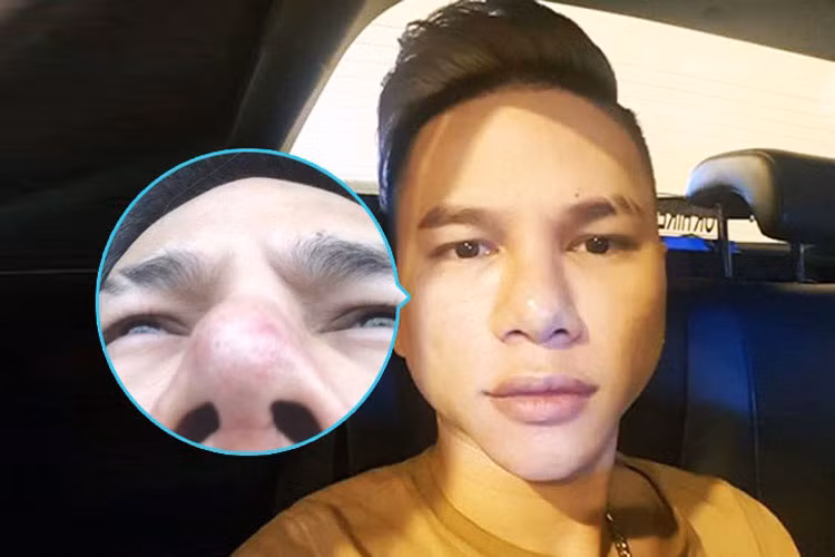 Vì gương mặt có biểu hiện bị dao kéo hỏng nên Hoàng Tôn quyết định chỉnh sửa mũi và cằm một lần nữa. Ảnh: FBNV