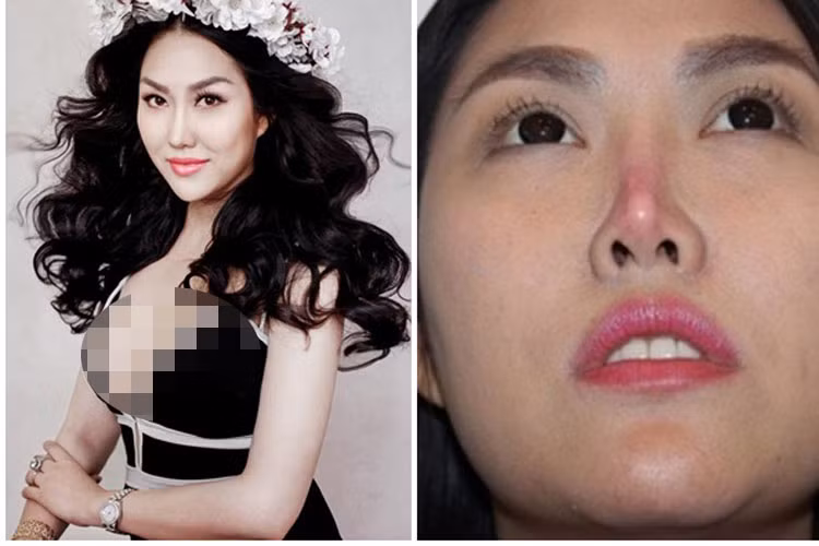 Đầu năm 2015, sau 11 năm đặt silicon sống mũi, Phi Thanh Vân bị biến chứng. Mũi của cô bị teo, lệch sang một phía, đầu mũi bị sưng tấy, có dấu hiện hoại tử. Ảnh: Vietnamnet