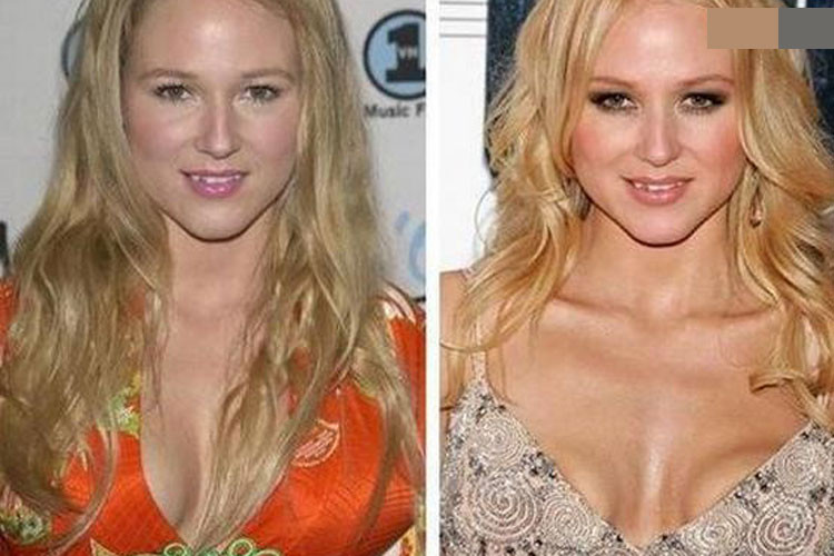 Nữ ca sĩ Jewel là nạn nhân của phẫu thuật nâng ngực hỏng. Vòng một của cô méo mó, xô lệch. Ảnh: Surgery Stars Mời quý độc giả xem clip "Những rủi ro từ phẫu thuật đặt túi ngực". Nguồn Youtube/VTC: