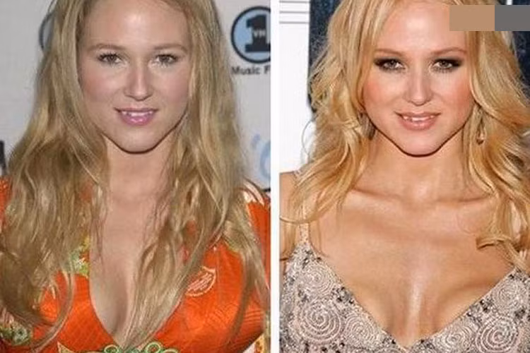 Nữ ca sĩ Jewel là nạn nhân của phẫu thuật nâng ngực hỏng. Vòng một của cô méo mó, xô lệch. Ảnh: Surgery Stars Mời quý độc giả xem clip "Những rủi ro từ phẫu thuật đặt túi ngực". Nguồn Youtube/VTC: