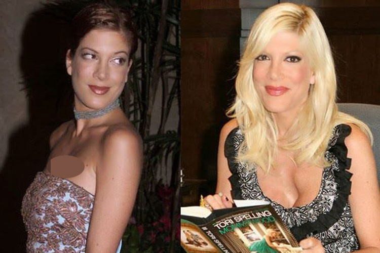 Lạm dụng nâng ngực, nữ diễn viên người Mỹ Tori Spelling gặp biến chứng ngực méo mó, lồi lõm. Ảnh: Pinterest