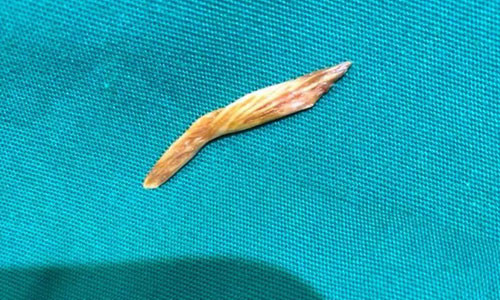 Xuong ca dam thung hau mon