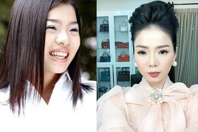 Trước khi phẫu thuật thẩm mỹ, Lệ Quyên sở hữu chiếc mũi tẹt. Ảnh: Saostar