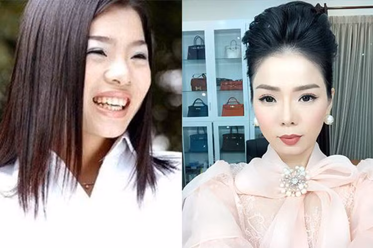 Trước khi phẫu thuật thẩm mỹ, Lệ Quyên sở hữu chiếc mũi tẹt. Ảnh: Saostar